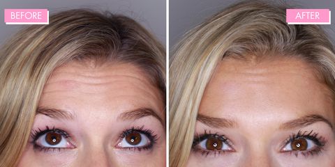 Botox injections pros and cons